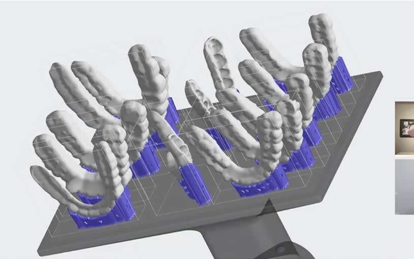 Tech Tip: Success with KeySplint Nightguards