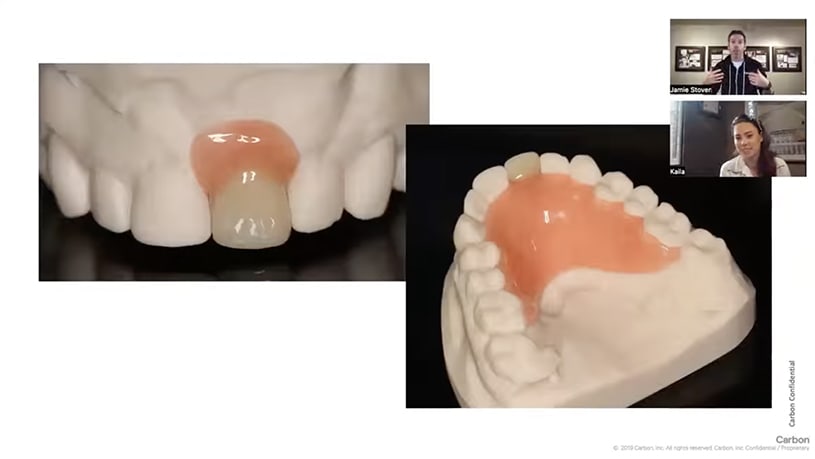 Tech Tip: Utilizing Lucitone Digital Print for Partial Dentures